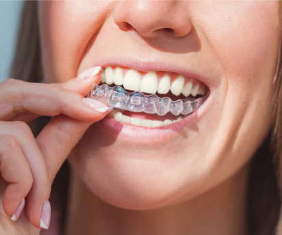 5 Reasons More Adults Are Choosing Clear Aligners Over Traditional Braces